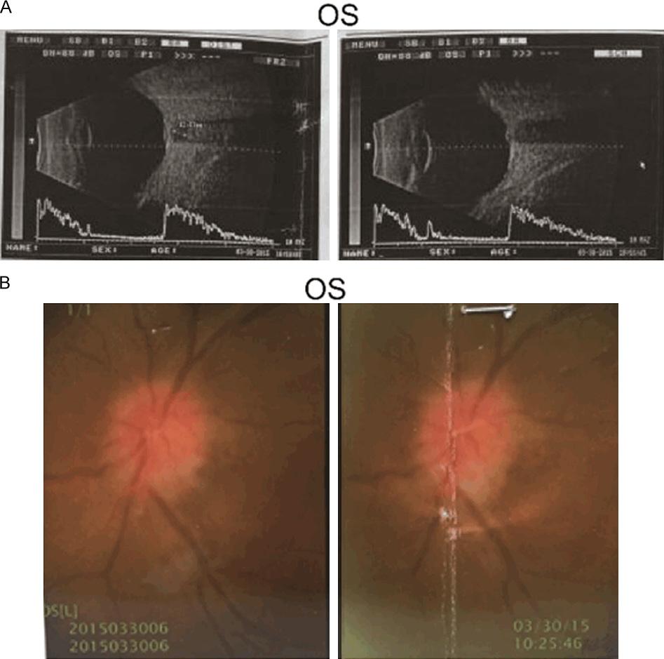 Figure 1. Eye B ultrasonic examination and funduscopic examination of left eye in other institution. A. B ultrasonic examination showed a vitreous turbidity and papilledema in left eye. B. Fundus microscope presented a fuzzy boundary of left optic disc.