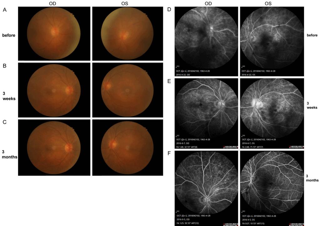 Figure 2. Fundus photograph (A-C) and fluorescein angiography (D-F) of the eyes before and after penicillin treatment. A.