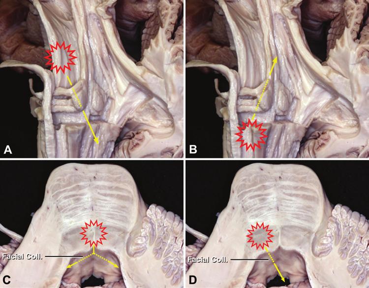 K. Yagmurlu et al. FIG. 2. Possibilities of displacement (arrow) of the facial colliculus according to different lesion locations (starburst).