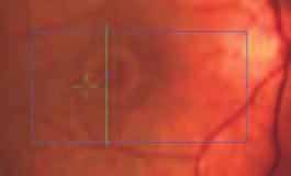Epiretinal Membrane The RTA 5 is extremely effective