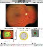 The RTA 5 provides practice building opportunities with multiple CPT reimbursable testing options for retina scanning and fundus imaging in baseline and follow-up reports.
