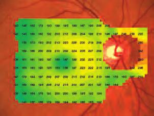 Average retinal thickness is determined at