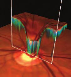 thickness measurements which help accurately detect and define retinal