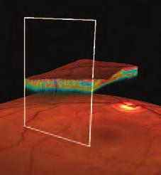 The 2D retinal thickness map layer can be modified using a transparency filter