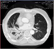 Despite excellent local control after SBRT, patient survival for medically inoperable early-stage lung cancer is very poor, mainly due to severe and lifethreatening coexisting morbidities and the
