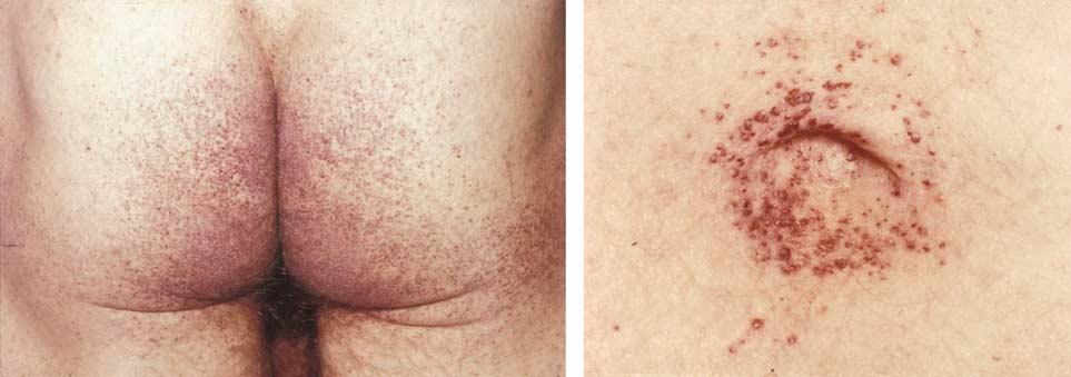 of each other, in Bonn and London, respectively. They described patients with angiokeratoma corporis diffusum, the red-purple maculopapular skin lesions characteristic of the disorder (Figure 3).
