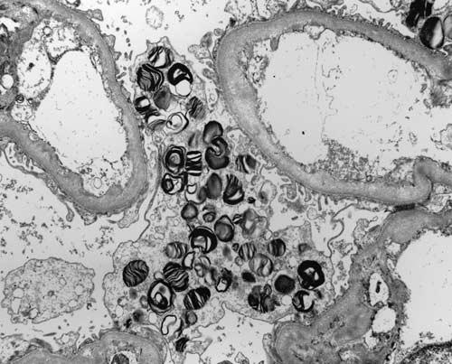 Figure 6 Electron micrograph showing electron-dense laminated myelin figures in glomerular epithelial cells ( 5000). mutant enzymes with very low activity.