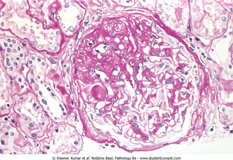 focal and segmental glomerulosclerosis (PAS stain).