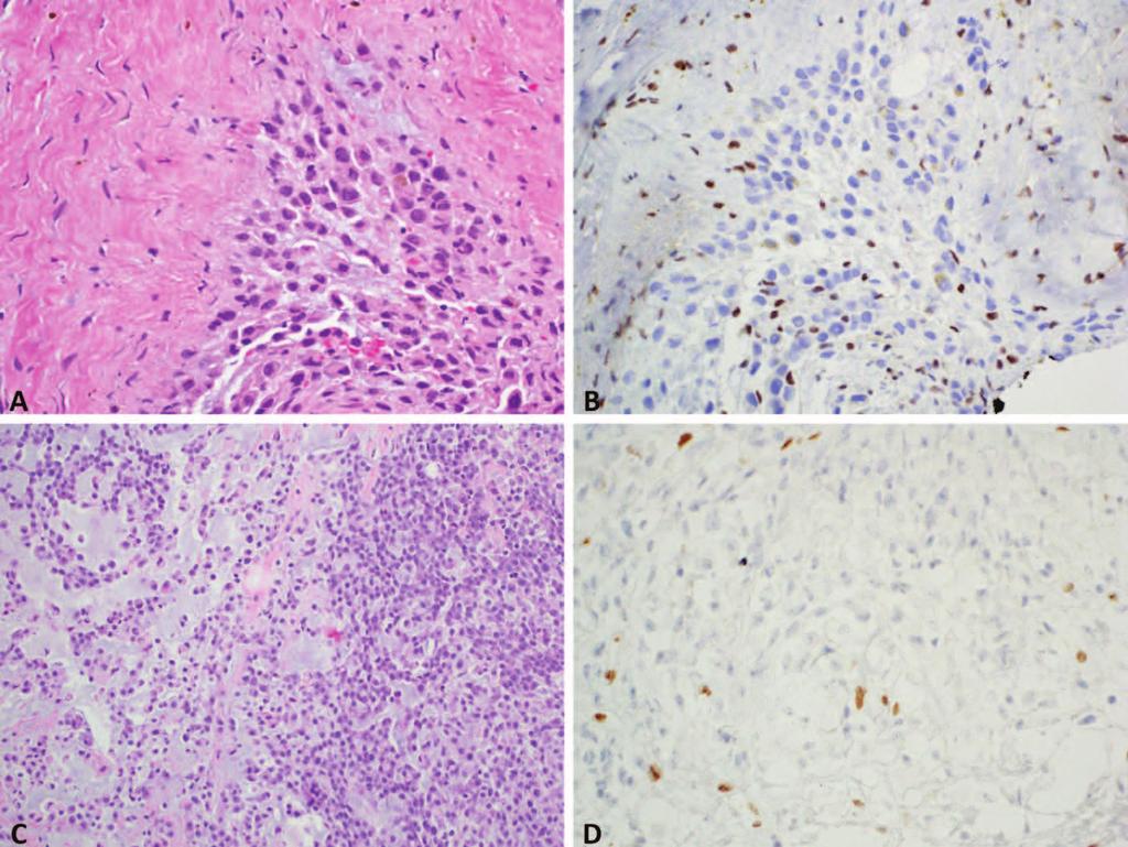 Figure 8. Proximal-type epithelioid sarcoma, which may mimic carcinoma or melanoma, (A) shows diffuse loss of nuclear INI1, in contrast to surrounding normal cells (B).