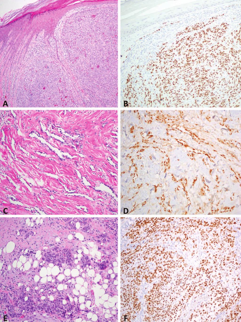 Figure 1. Nodular Kaposi sarcoma involving dermis composed of fascicles of spindle cells with numerous extravasated red blood cells (A). The tumor cells show diffuse nuclear expression of ERG (B).