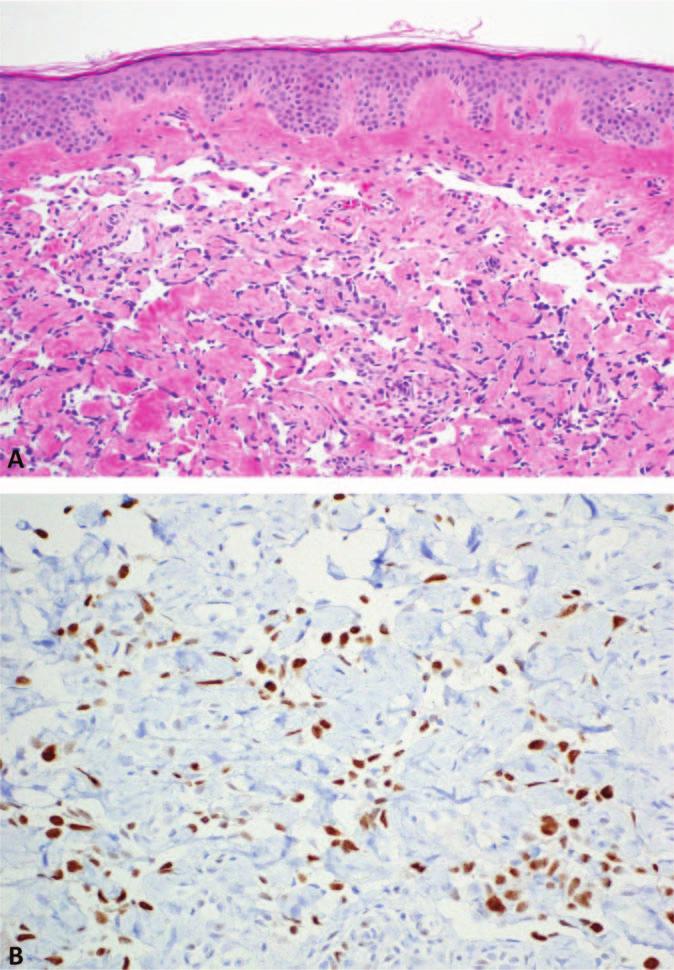 Figure 2. Postradiation angiosarcoma with a vasoformative growth pattern (A).