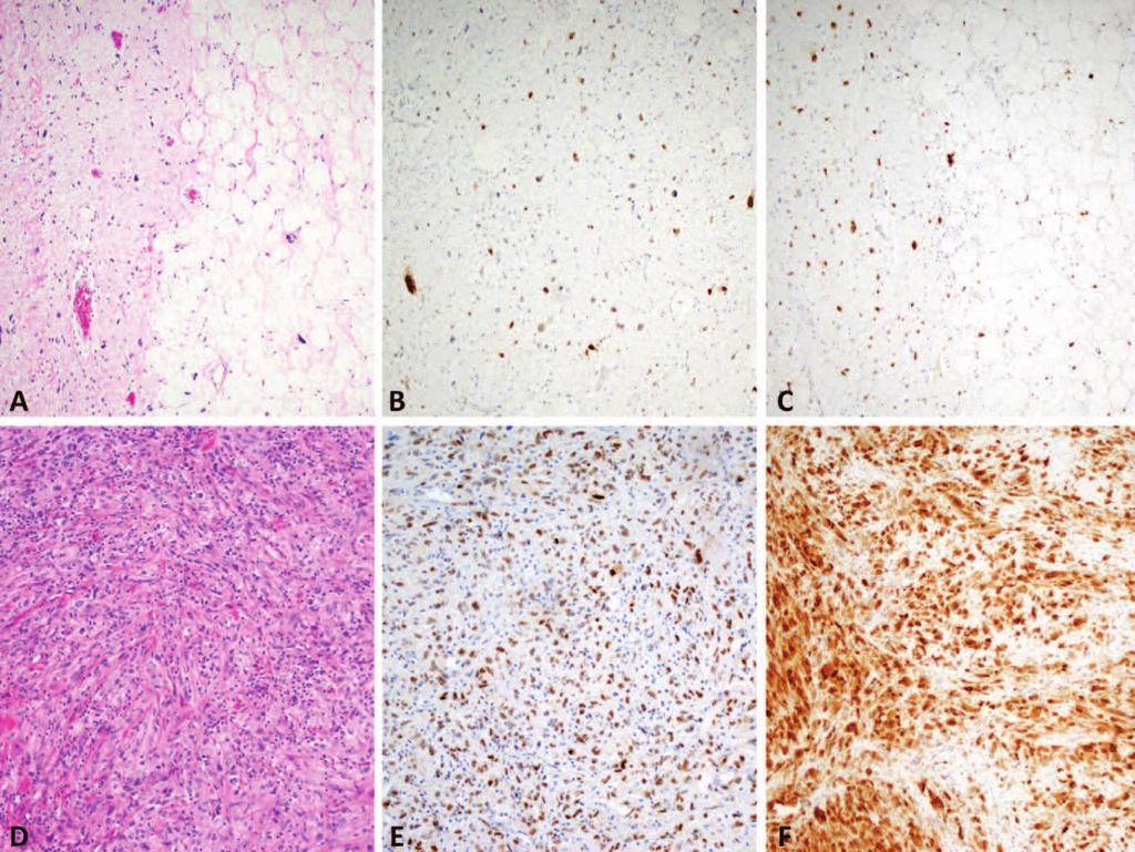 Figure 3. Well-differentiated liposarcoma with scattered hyperchromatic atypical spindle cells (A). The tumor cells are positive for MDM2 (B) and CDK4 (C).