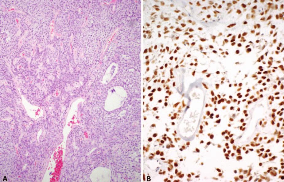 Figure 4. Solitary fibrous tumor with characteristic hemangiopericytoma-like branching vessels and focally myxoid features (A).
