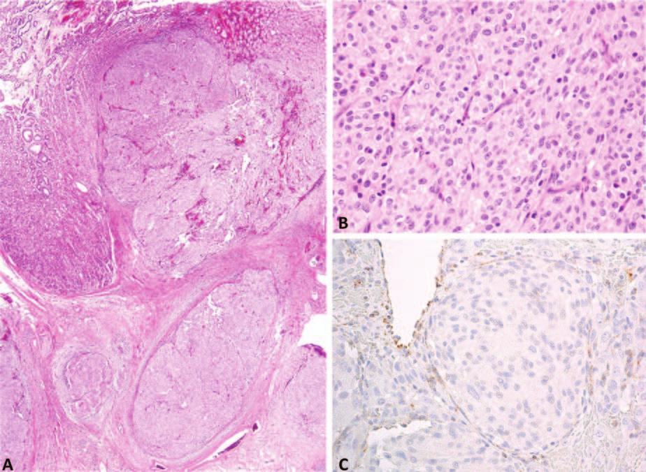 Figure 7. Succinate dehydrogenase (SDH) deficient gastrointestinal stromal tumor shows a characteristic multinodular or plexiform growth pattern (A), and tumor cells are usually epithelioid (B).