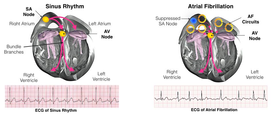 Melbourne Heart Rhythm Pacemaker and AV Node Ablation Patient Information The Heart The heart is a pump responsible for maintaining blood supply to the body. It has four chambers.