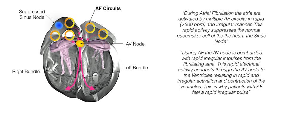 present. This is what happens in atrial fibrillation. Multiple electrical short circuits develop in the upper heart chambers as shown in the diagram below.