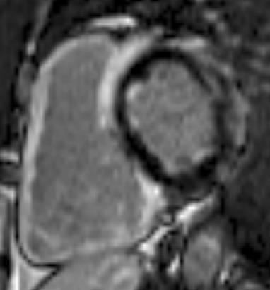 Sarcoidosis Differing LGE