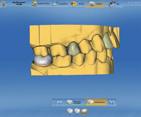Multi-tooth design and even simultaneous design in multiple quadrants to
