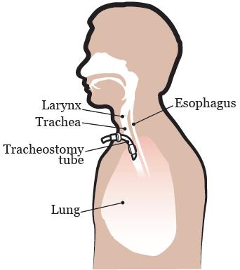 PATIENT & CAREGIVER EDUCATION Caring for Your Tracheostomy This information will help you care for your tracheostomy while you re in the hospital and at home.