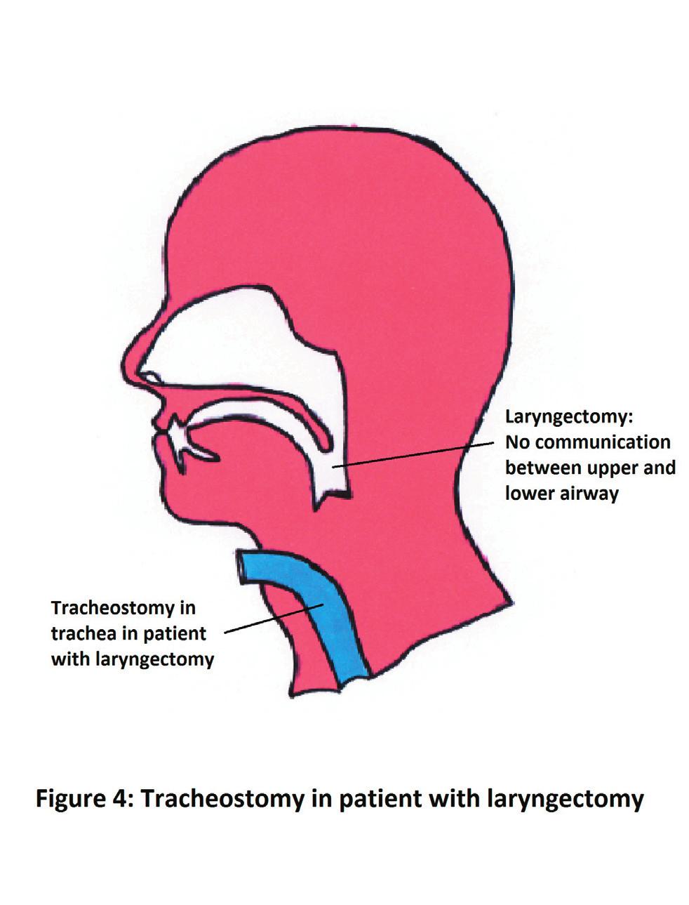 It is important to note that if the tracheostomy is occluded the patient cannot breathe unless the cuff is deflated and air-flow around the tube is permitted.