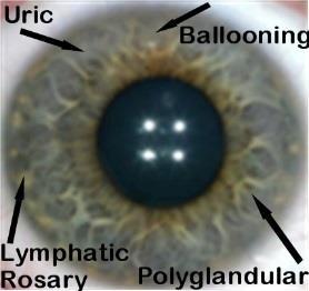 Lymphatic (Blue eye)-- Allergies, Overactive immune system; Colds, Sinus, Respiratory infections, GI disorders; Arthritis, Adrenal, Kidney