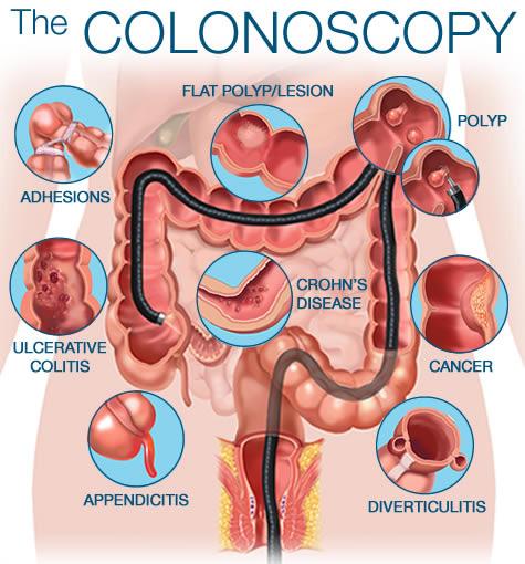 Colonoscopy Procedure Overview Please Read {Prior to the Procedure What is a Colonoscopy?
