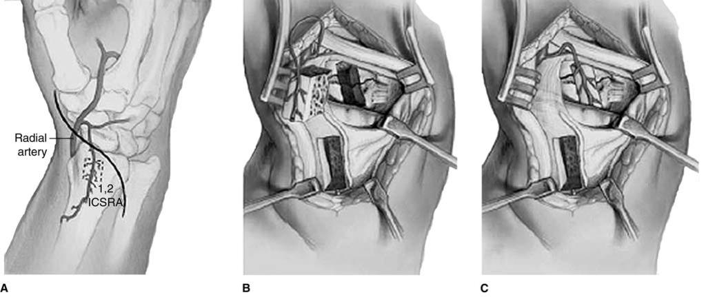Pedicled Vascularized Bone Grafts for Scaphoid and Lunate Reconstruction Figure 1 Illustrations of surgical technique for 1,2 intercompartmental supraretinacular artery (1,2 ICSRA) graft by the