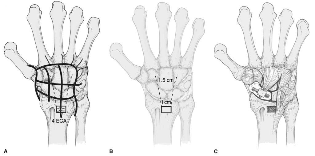 Alexander Payatakes, MD, and Dean G. Sotereanos, MD Figure 2 Illustrations of a capsule-based vascularized bone graft artery by the dorsal approach. A, Vascular anatomy of the dorsal wrist.