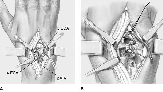 Pedicled Vascularized Bone Grafts for Scaphoid and Lunate Reconstruction Figure 4 Illustrations of the surgical technique for a fourth and fifth extensor compartmental artery (4 + 5 ECA) graft.
