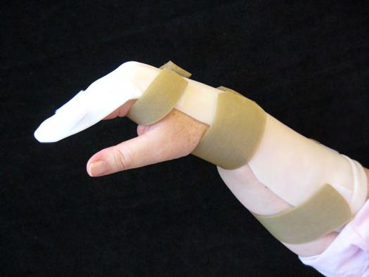 Initial care Antibiotics Tetanus Dorsal block splint Primary wound closure Arrange follow up with hand