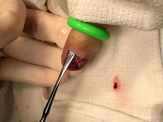 Suture repair along edges of finger first, then nailbed if