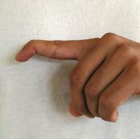 Mallet finger (minus laceration) disruption of