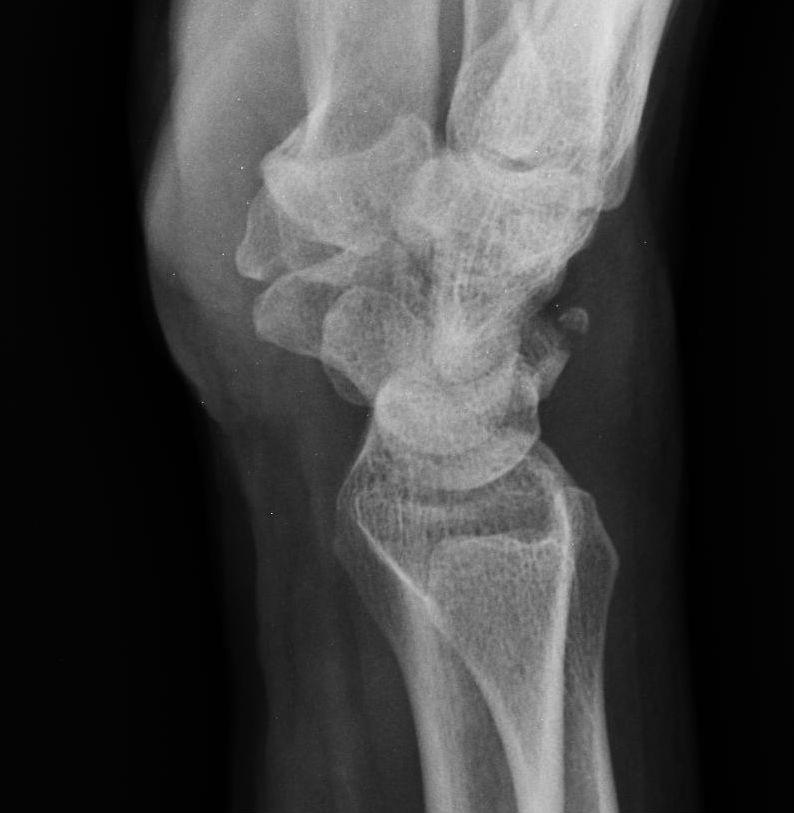 Triquetral chip fracture Short arm cast or removable brace x 3-4
