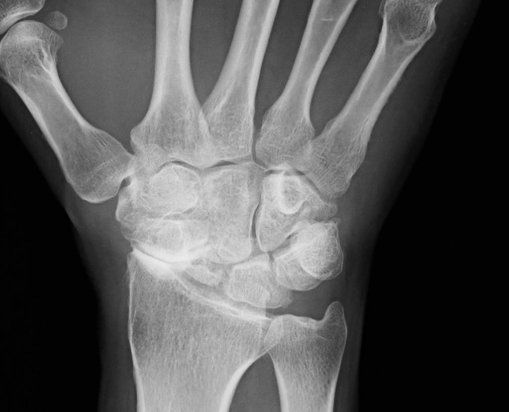 Wrist arthritis May have remote or recent history of injury Often
