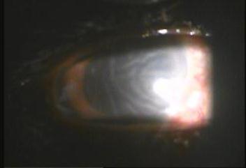 2: Showing fixed dilated pupil