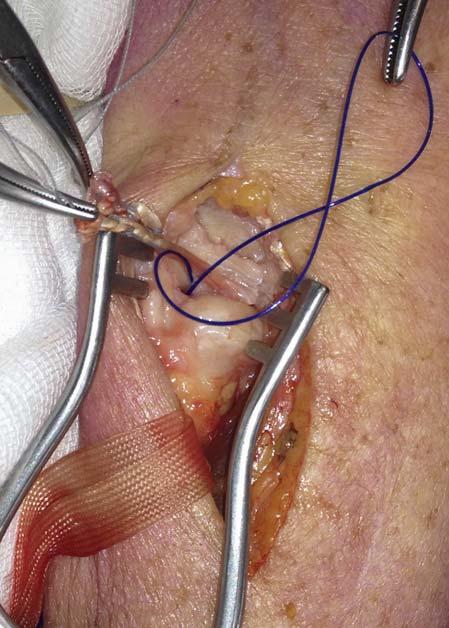 The palmaris longus graft has been passed through the triangular fibrocartilage complex (TFCC).