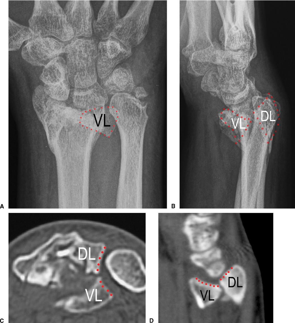 482 SIGMOID NOTCH RECONSTRUCTION BY OSTEOTOMY FIGURE 1: A D Plain x-rays at the first visit (4 months after the injury).