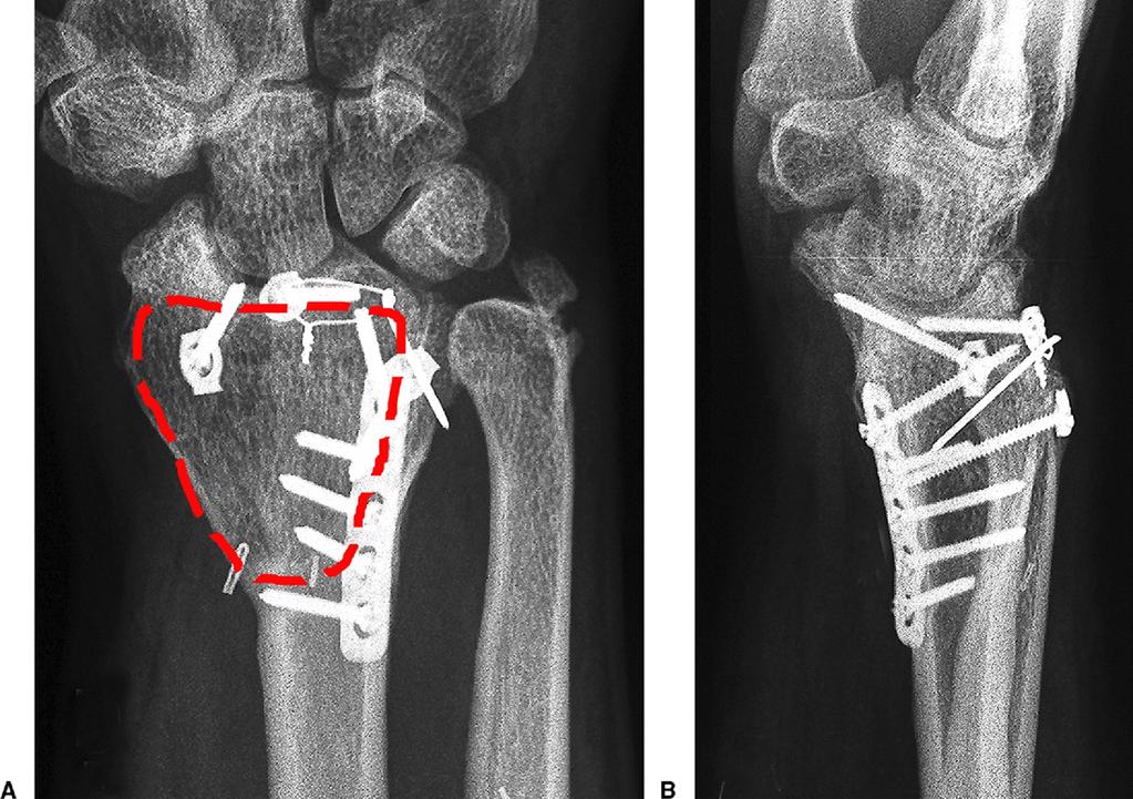 484 SIGMOID NOTCH RECONSTRUCTION BY OSTEOTOMY FIGURE 4: A, B Plain x-rays at 2.5 years. The outlines of the corticoperiosteal flap have been marked. moid notch, was mobilized and swung ulnarly.