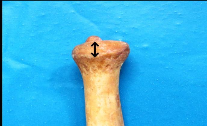 All dry ulnae were inspected carefully and those damaged at the head of ulna and ones showing obvious pathology like healed