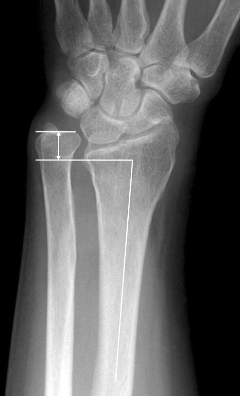 297 the DRUJ was quantified preoperatively by measuring the radioulnar distance 15) on a true lateral radiograph of the wrist, in which the pisoscaphoid distance was less than 3 mm