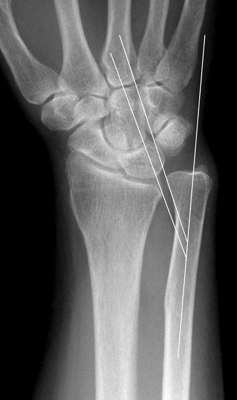 (B) Measurement of ulnar variance (arrows) on the postoperative anteroposterior wrist radiograph. Fig. 2.