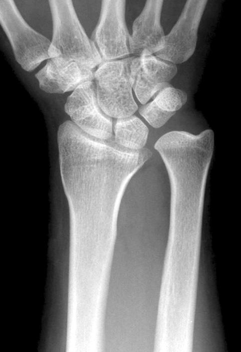 No osteoarthritic changes of the distal radioulnar joint (DRUJ) were seen. (B) Osteoarthritic changes of the DRUJ after a follow-up period of 44 months. variance and the radioulnar distance.