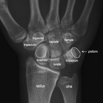 General introduction 13 1 Fig. 1 Bones of the authors wrist joint The radius and the ulna are the long bones of the forearm.