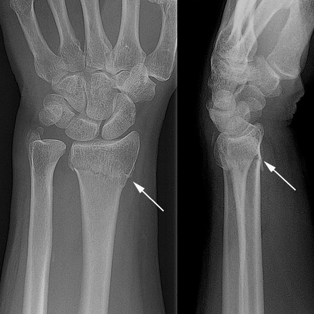14 Chapter 1 Fig. 2 A radiograph of a fractured radius showing a characteristic transverse fracture with dorsal displacement of the distal end of the radius. ulnar-carpal abutment.