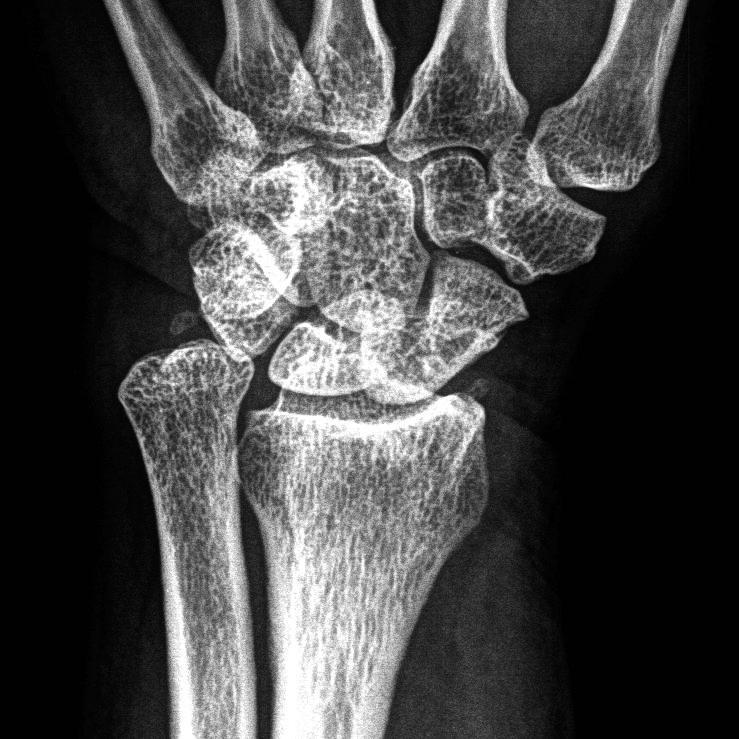 General introduction 15 1 Fig. 3 A severe example of a malunited distal radius. There is an ulnar plus present and the radial inclination is reduced.