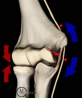 ligament Caused by repetitive valgus