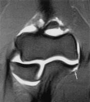 Imaging MR arthrography: a partial-thickness tear of the UCL at the attachment on the sublime tubercle Treatment 3 to 6 months of rehabilitation Avoid valgus stress Isometric strengthening:
