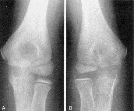 Imaging X-ray elbow Irregularity and delayed development of