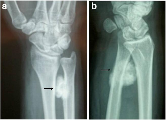 Spinelli et al. World Journal of Surgical Oncology 2012, 10:260 Page 2 of 5 Figure 1 Antero-posterior (a) and lateral (b) view of wrist showing the ossifying mass surrounding the distal ulna.