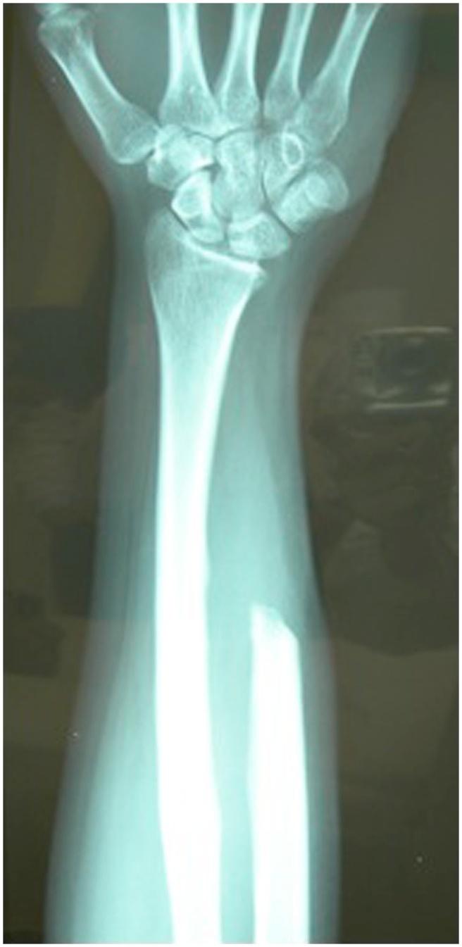 Fifteen months after surgery, the new forearm X-ray showed a small round mass (diameter <1cm), which was localized about 5 cm proximally from the ulnar resection site in the interosseous membrane